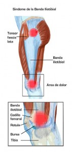 Zonas de dolor de la Cintilla