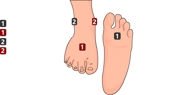 Metatarsalgia Electroestimulación