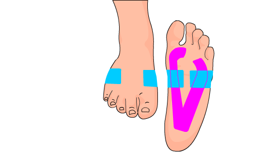 Metatarsalgia Kinesiotape